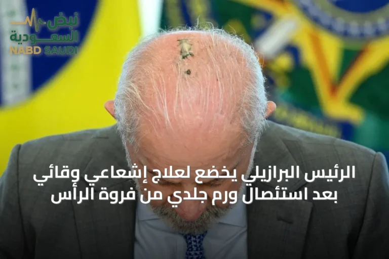 الرئيس البرازيلي يخضع لعلاج إشعاعي وقائي بعد استئصال ورم جلدي من فروة الرأس