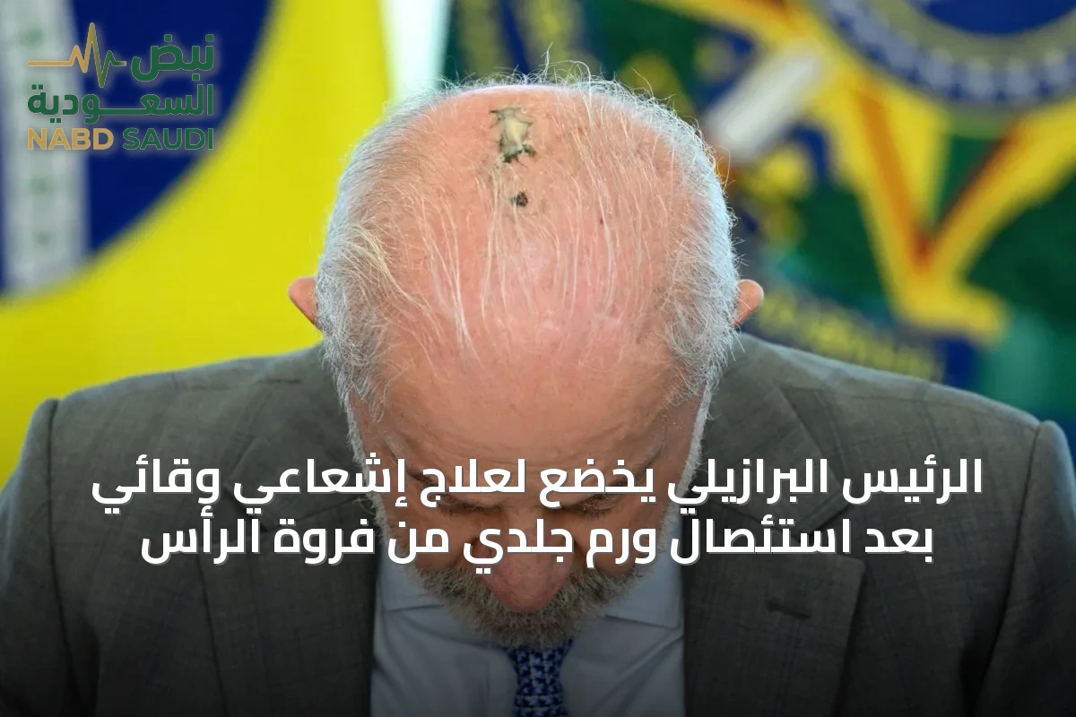 الرئيس البرازيلي يخضع لعلاج إشعاعي وقائي بعد استئصال ورم جلدي من فروة الرأس