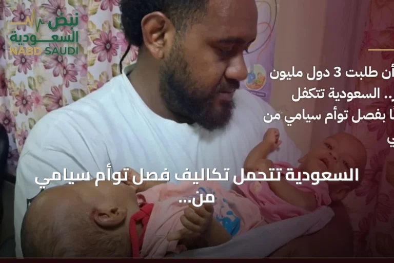 السعودية تتحمل تكاليف فصل توأم سيامي من فيجي بعد رفض ثلاث دول دفع مبلغ مسبق
