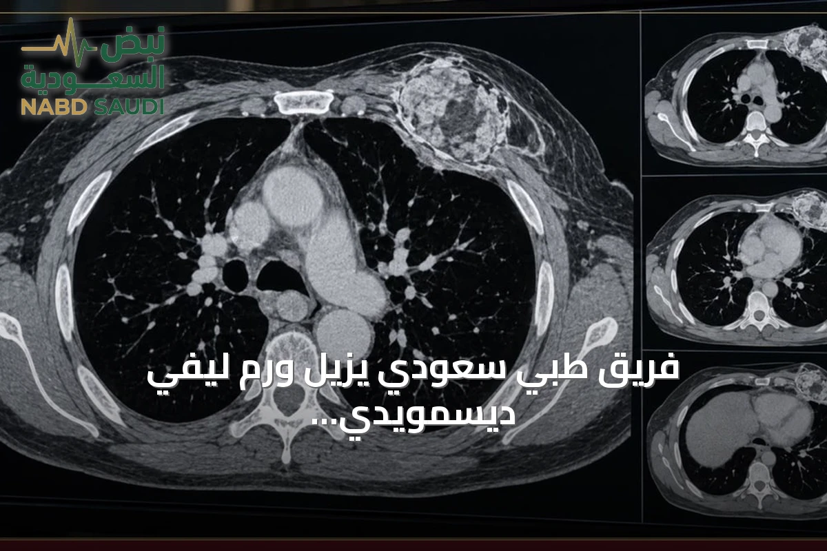 فريق طبي سعودي يزيل ورم ليفي ديسمويدي نادر من ثدي مريضة بمستشفى الملك Abdullah الجامعي
